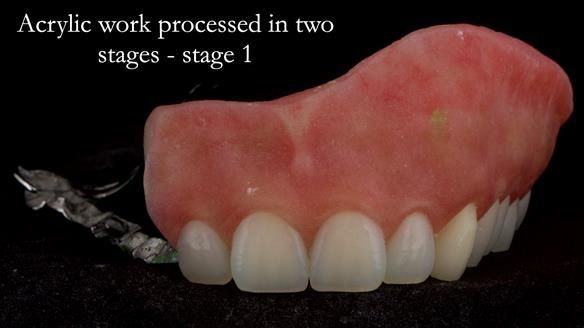 Upper metal base partial denture/occlusal stabilisation splint/obturator - full protocol