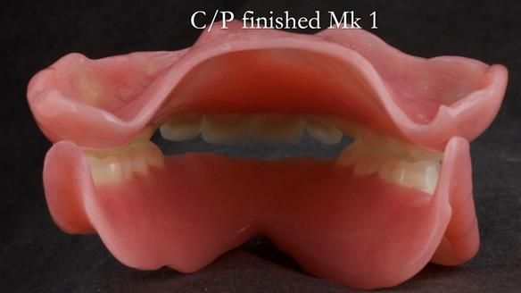 Newsletter 52 Managing Jo’s failing dentition with extractions and Mk 1/Mk 2 complete upper dentures and lower partial dentures FULL PROTOCOL