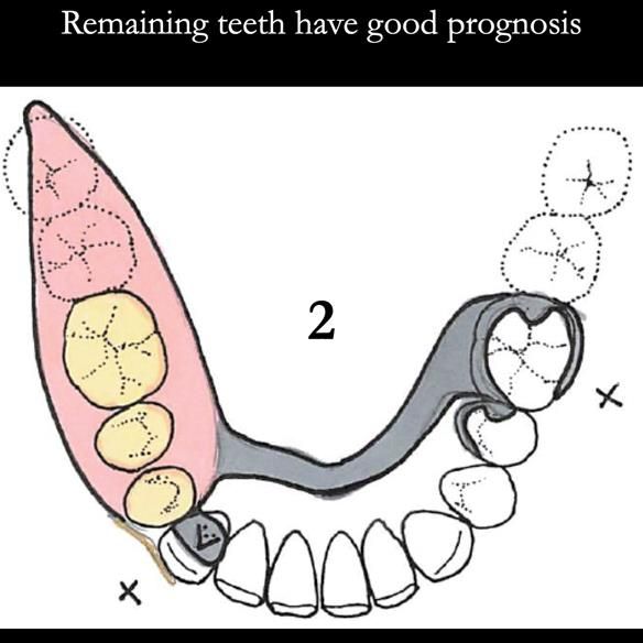 Universal Scandinavian partial denture designs