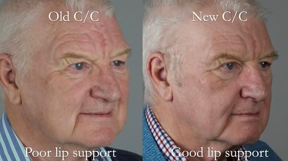 Newsletter 57 showcases the making and fitting process of implant-supported complete dentures for Alisdair