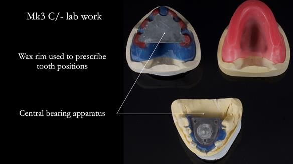 Newsletter 77: Jeremy’s case – immediate complete upper denture