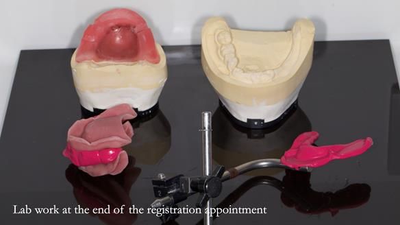 Newsletter 82 Mary - A complete upper and a one-tooth gasket denture