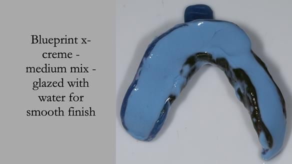 Newsletter 55 Provision of metal based partial dentures for Zephyrine with a repaired cleft lip and palate