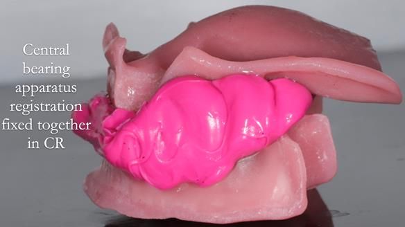 Finlay's Newsletter 59 Ultra hard partial dentures made for Gill