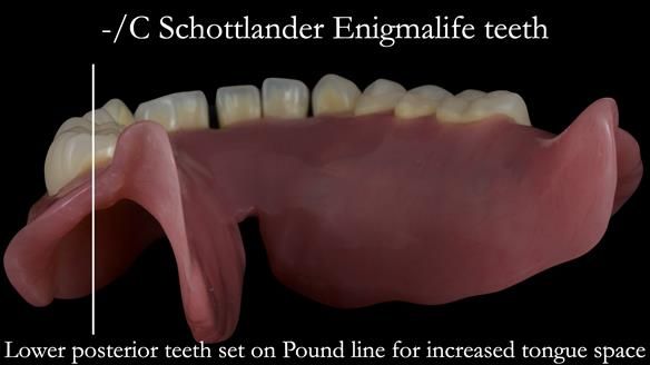 Newsletter 53 showing the making and fitting of ultra life-like dentures for Valena
