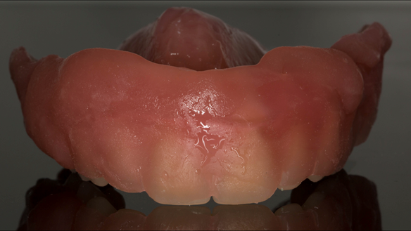 Figure 45 The reline material flows over the labial aspect of the teeth. The wax on the labial surface of the teeth speeds up cleaning because it prevents the material from running into the embrasures. This image shows the reline when removed from the mou