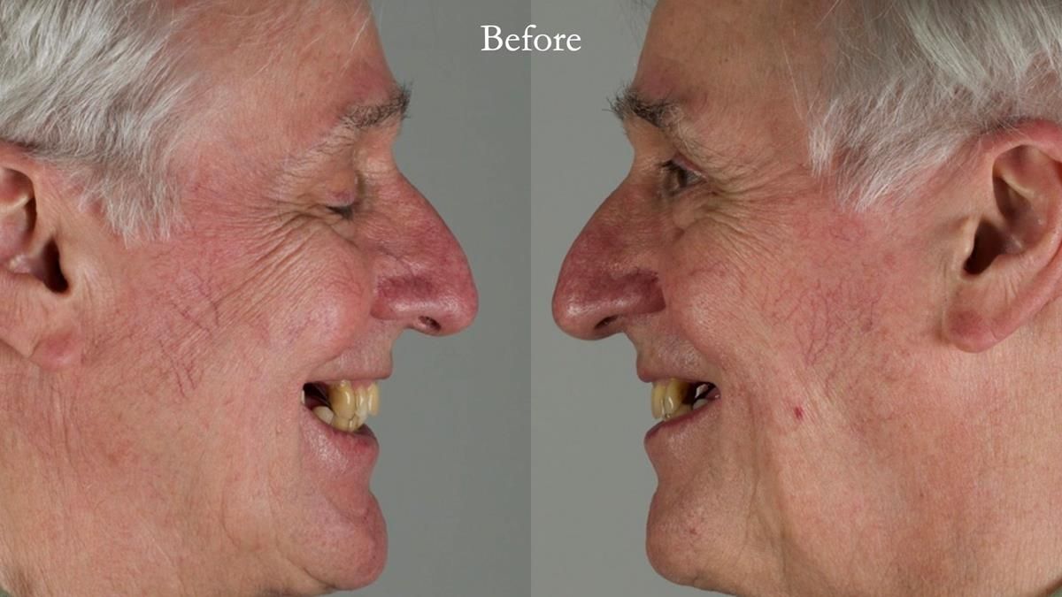 Newsletter 89 – Simon: A Challenging Kennedy Class II Division 1 Upper CoCr Partial Denture with a High Smile Line