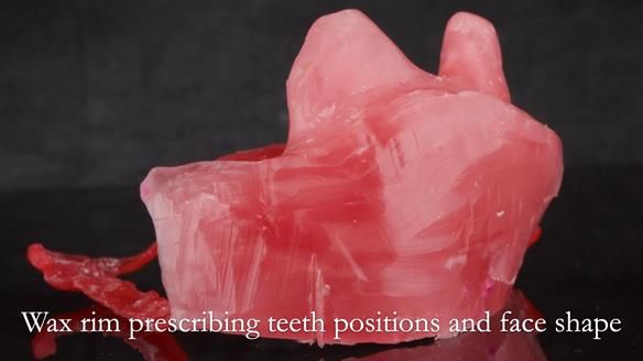 Upper metal base partial denture/occlusal stabilisation splint/obturator - full protocol