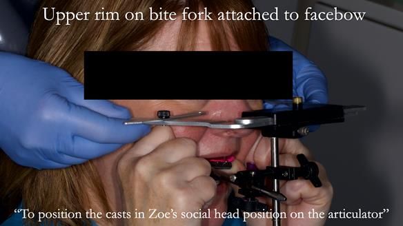 Finlay's Newsletter 58 Gasket upper partial denture for Zoe