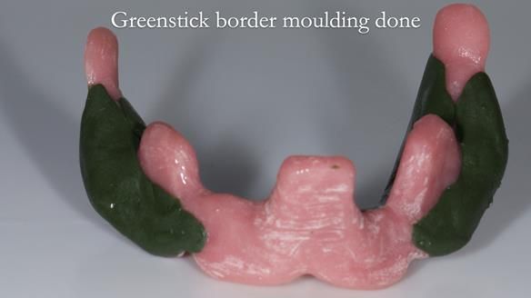 Newsletter 75: Marion’s case - Step-by-step complete denture workflow