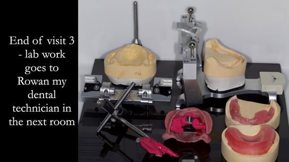 Complete denture Class II div 2 deep overbite Newsletter 39