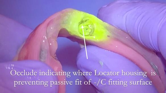Managing poor implant positioning with complete dentures and Locator attachments - full protocol Newsletter 41