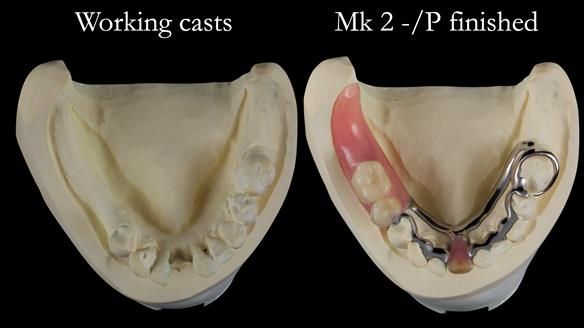 Newsletter 54 case presentation upper complete denture and lower Scandinavian designed hygienic partial denture for David