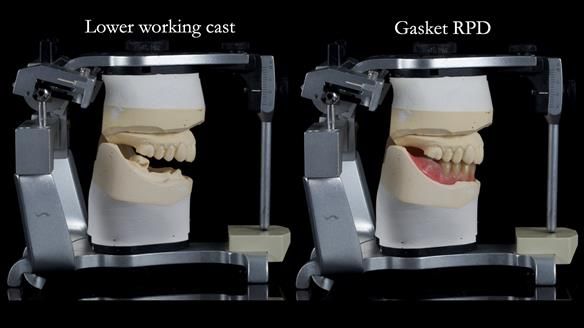 Newsletter 82 Mary - A complete upper and a one-tooth gasket denture