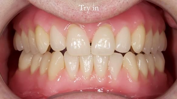 Newsletter 57 showcases the making and fitting process of implant-supported complete dentures for Alisdair