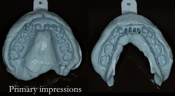 Figure 16 Primary impression with Dentsply Blueprint