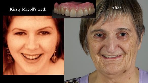 Newsletter 83: Sheila’s Complete Denture Success