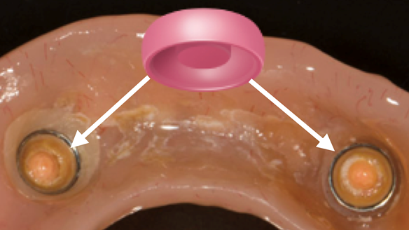Figure 9 This results in deformation damage to the attachments