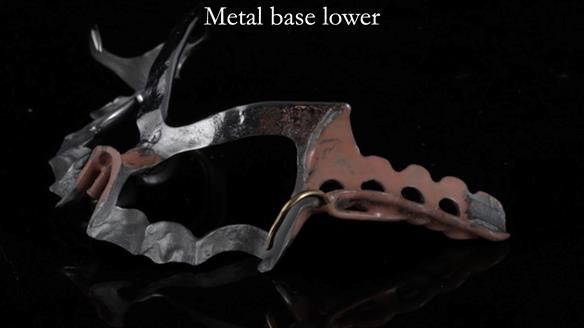 Newsletter 54 case presentation upper complete denture and lower Scandinavian designed hygienic partial denture for David