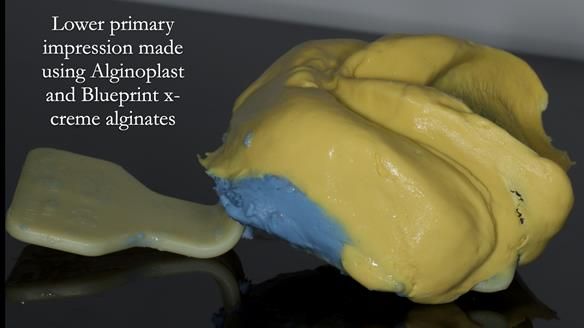 Newsletter 83: Sheila’s Complete Denture Success