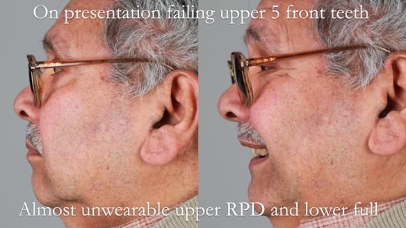 Finlay's Newsletter 62 provision of extractions and metal based complete dentures for Rafique