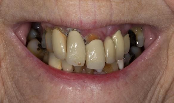 Figure 2 Pre - treatment. High smile line and failing upper teeth.