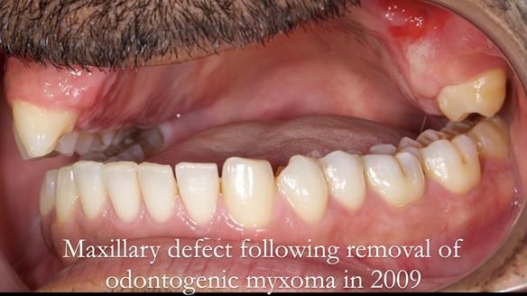 Upper metal base partial denture/occlusal stabilisation splint/obturator - full protocol