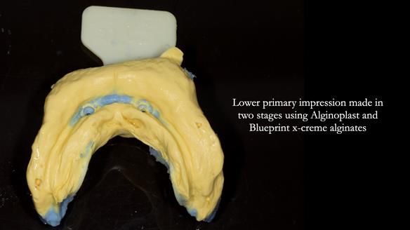 Newsletter 78: What do Clark Gable and a Locator® overdenture have in common?