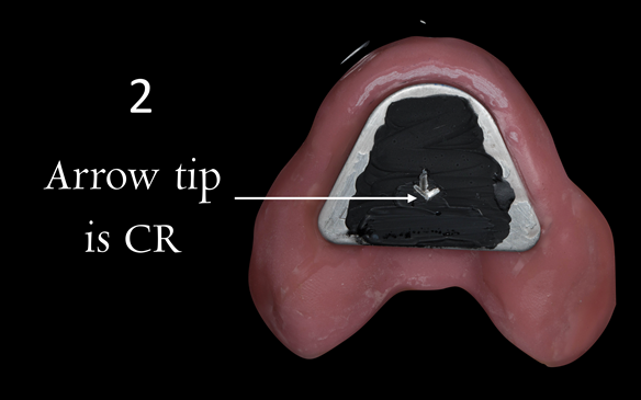 Figure 90 Visit 3 for Mk 2 fabrication. Inter-maxillary registration with central bearing apparatus. Maxillary plate with china graph pencil marking with arrow head scribed showing precise CR