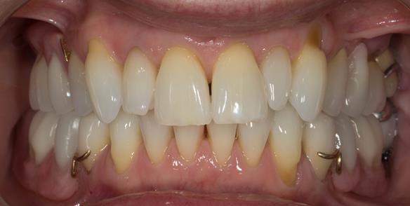 Figure 86 Definitive dentures fitted.