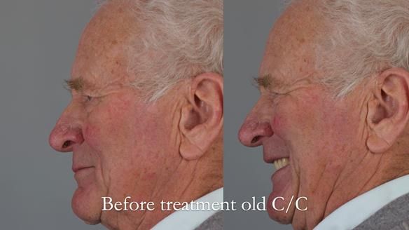 Complete denture Class II div 2 deep overbite Newsletter 39