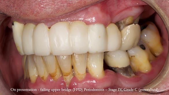 Newsletter 77: Jeremy’s case – immediate complete upper denture