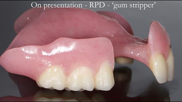 Finlay's Newsletter 59 Ultra hard partial dentures made for Gill