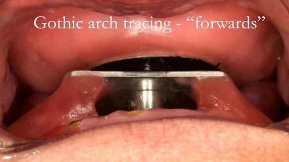Sequence of use - patient is instructed to move lower jaw back - this is near centric relation