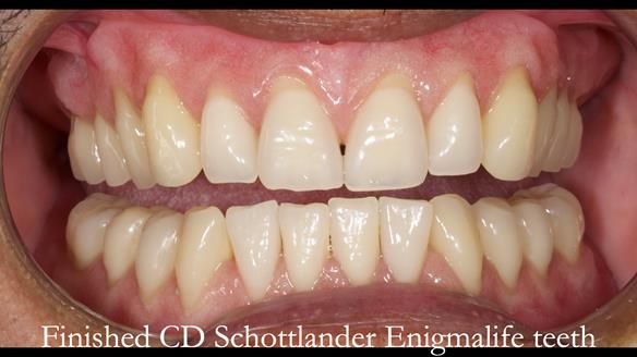 Finlay's Newsletter 62 provision of extractions and metal based complete dentures for Rafique