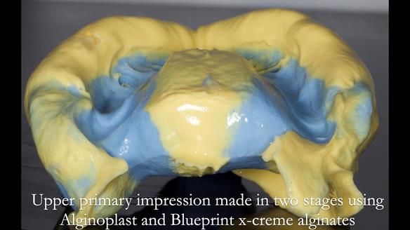 Newsletter 57 showcases the making and fitting process of implant-supported complete dentures for Alisdair