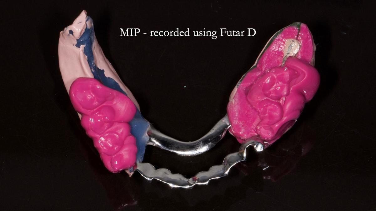 Newsletter 87 – Father Peter: A Partial Denture that needed Minor Miracle