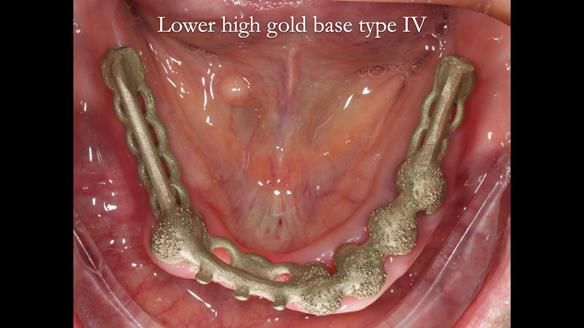 Newsletter 76: Jackie’s case – Telescopic overdenture & precision RPD (the tricky truth!)