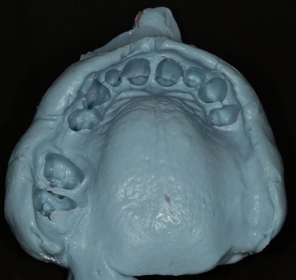 Figure 58 Working impression in custom tray with greenstick and alginate