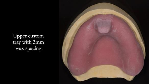 Newsletter 75: Marion’s case - Step-by-step complete denture workflow