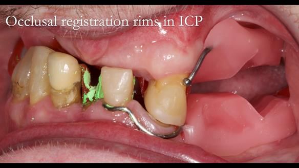 Newsletter 55 Provision of metal based partial dentures for Zephyrine with a repaired cleft lip and palate