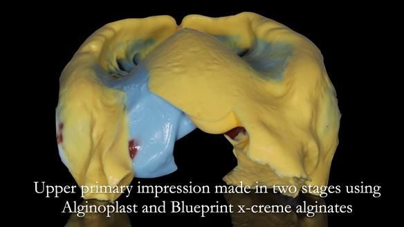 Newsletter 56 showing the making and fitting of a bilateral free end saddle upper removable partial denture (RPD) for patient with pemphigus