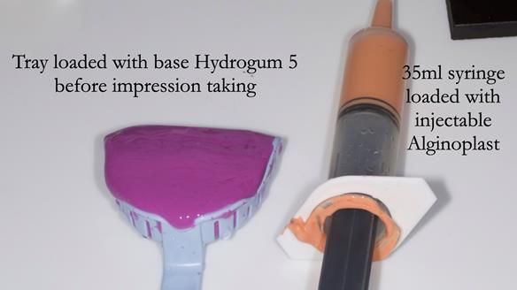 Finlay's Newsletter 64 case study - provision of a Kennedy class 2 metal based Scandinavian RPD for Ian