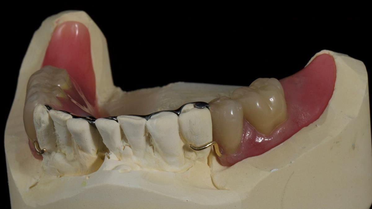 Newsletter 87 – Father Peter: A Partial Denture that needed Minor Miracle