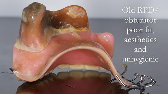 Upper metal base partial denture/occlusal stabilisation splint/obturator - full protocol