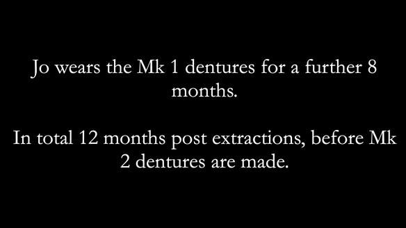 Newsletter 52 Managing Jo’s failing dentition with extractions and Mk 1/Mk 2 complete upper dentures and lower partial dentures FULL PROTOCOL