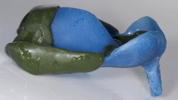 Newsletter 77: Jeremy’s case – immediate complete upper denture