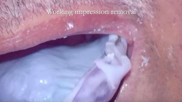 Finlay's Newsletter 62 provision of extractions and metal based complete dentures for Rafique