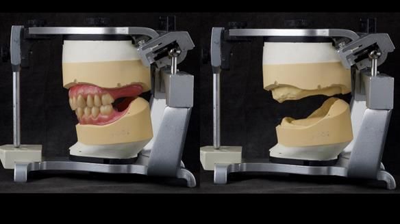 Complete denture Class II div 2 deep overbite Newsletter 39