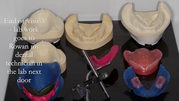 Newsletter 53 showing the making and fitting of ultra life-like dentures for Valena